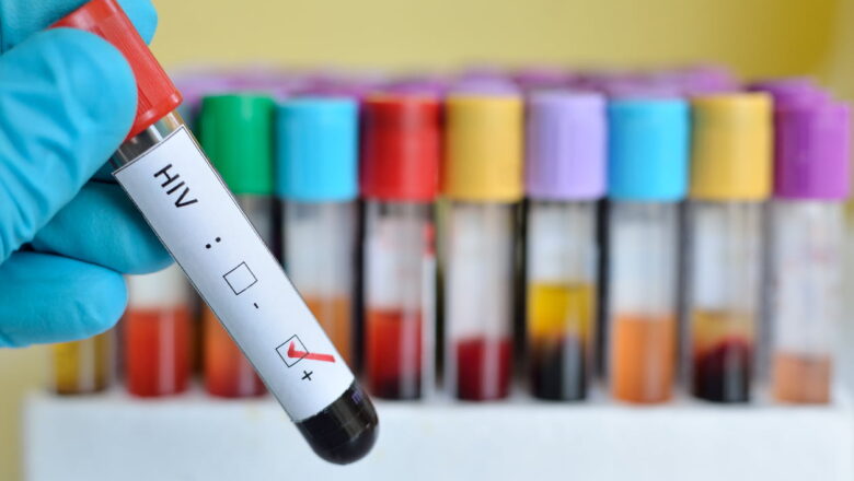 ‘Yan Najeriya miliyan 2 ne ke fama da cutar Kanjamau me karya garkuwar jiki: Karanta Jadawalin Jihohin da suka fi yawan masu cutar a Najeriya